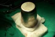 Шок*! Металлическую чашку, диаметром 10 см. удалили из «недр» организма пожилого индийца. (Видео) 0