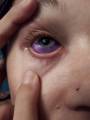 Канадская модель плачет пурпурными слезами после нанесения татуировки на глаз. (Видео) 3