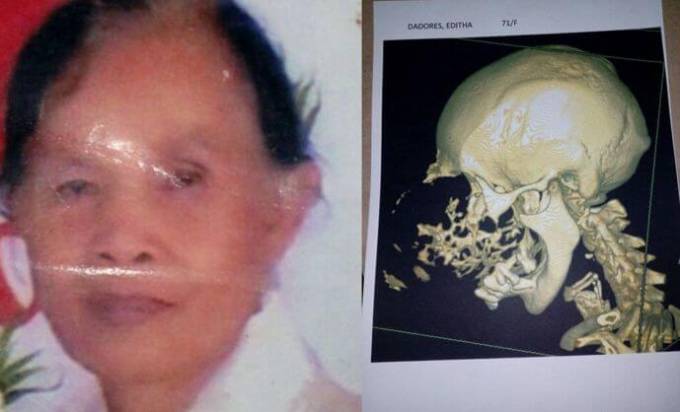 ШОК+! Гигантская опухоль обезобразила лицо пожилой филиппинки. (Видео)