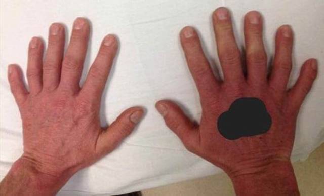 Ананд Саггар (Anand Saggar), старший генетический консультант в больнице Святого Георгия, в Лондоне заявил, что с лишними пальцами на руках и на ногах рождается каждый 500-ый гражданин Туманного Альбиона.