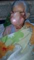 ШОК+! Гигантская опухоль обезобразила лицо пожилой филиппинки. (Видео) 5