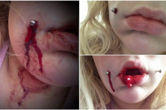 Девушка, пожелавшая сделать ямочки на щеках в пирсинг - салоне, сильно пожалела об этом