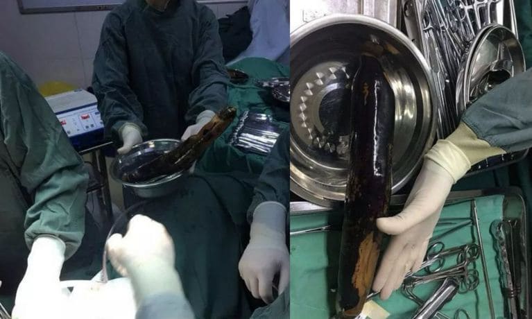 Китаец при помощи баклажана... попытался вылечить непроходимость прямой кишки Китаец при помощи баклажана... попытался вылечить непроходимость прямой кишки
