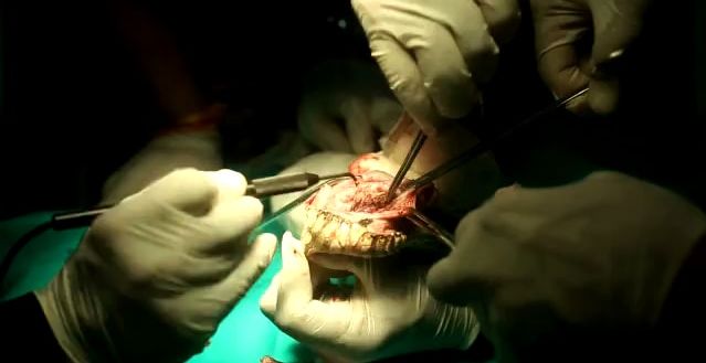 Хирурги удалили опухоль из пасти питона в индийском зоопарке. (Видео)
