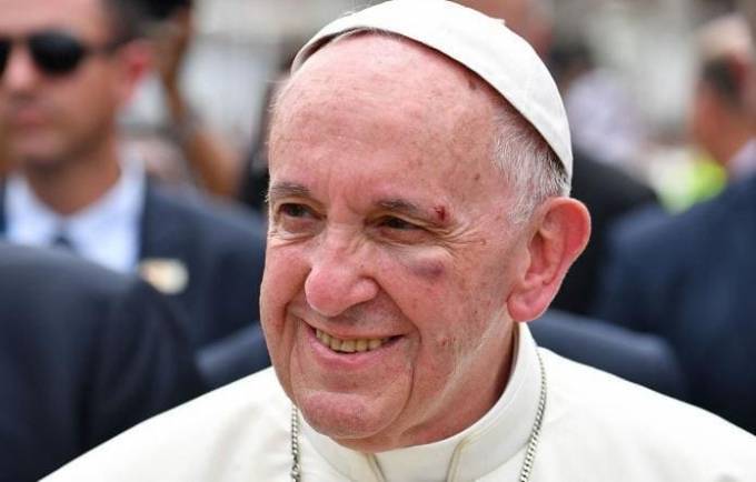 Папа Римский получил травму лица во время путешествия по Колумбии. (Видео)