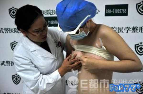 30-летний житель города Чжучжоу (провинция Хунань) несколько месяцев назад заплативший около 40000 юаней за операцию по увеличению груди, на днях отказался от странной "затеи" повысить своё благосостояние и удалил имплантанты.