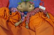 В Бангладеш попытаются разделить сросшихся головами близнецов. (Видео) 1