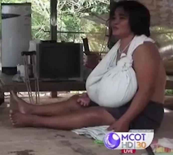 Женщина с огромной грудью поставила в тупик тайских медиков ▶