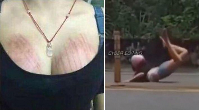 Мотоциклистка, не справившись с управлением своего байка, получила «дорожную сыпь» на груди