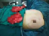 Операцию по уменьшению груди у 12-ти летнего мальчика провели в Китае. 3