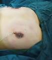 Операцию по уменьшению груди у 12-ти летнего мальчика провели в Китае. 1