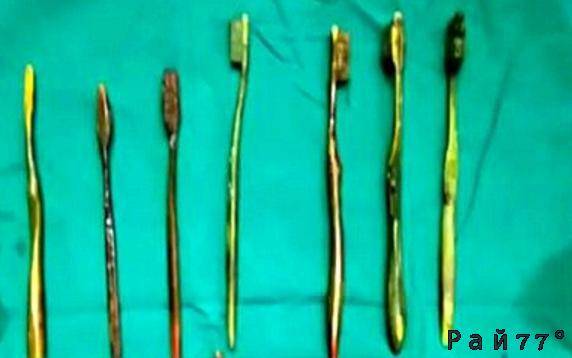 Китайские врачи недавно провели шестичасовую операцию и удалили из желудка девушки шесть зубных щёток и другие, менее крупные бытовые предметы.