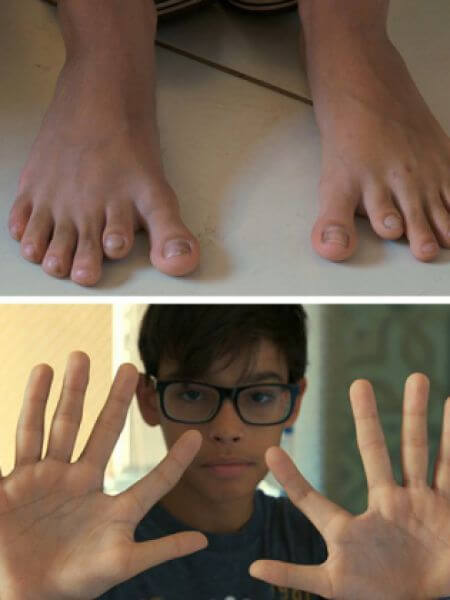 6 Пальцев На Ногах Фото