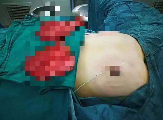 Операцию по удалению груди у 12-ти летнего мальчика провели в Китае.