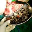 Человек копилка: индийские хирурги извлекли из желудка мужчины 263 монеты и 100 гвоздей 0