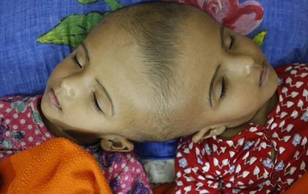 В Бангладеш попытаются разделить сросшихся головами близнецов. (Видео)