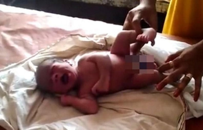 Мальчик с четырьмя ногами родился в Индии (Видео)