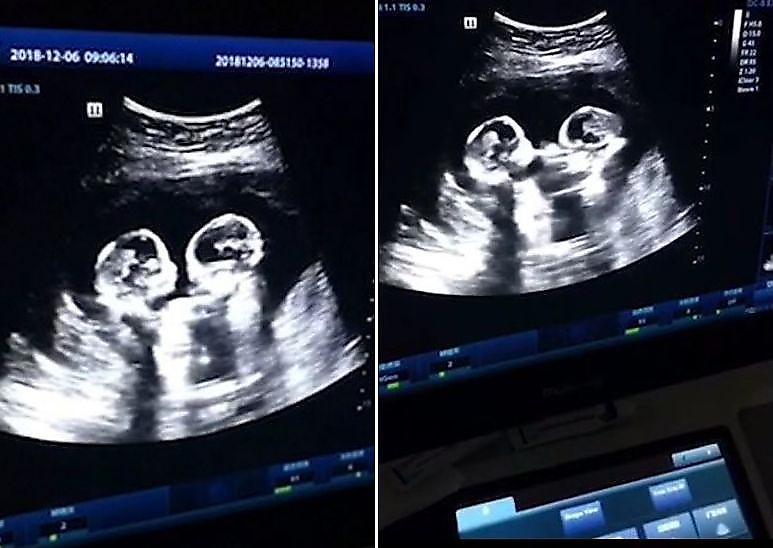 Драка двух сестёр-близнецов, в утробе матери, была запечатлена во время УЗИ в Китае ▶