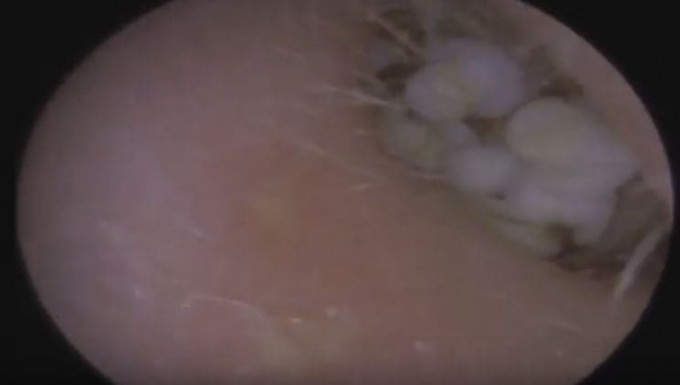 Врач удалил 22 посторонних предмета из уха пациента в Британии (Видео)