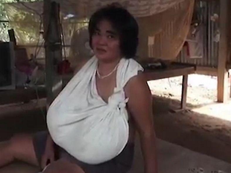 Женщина с огромной грудью поставила в тупик тайских медиков ▶
